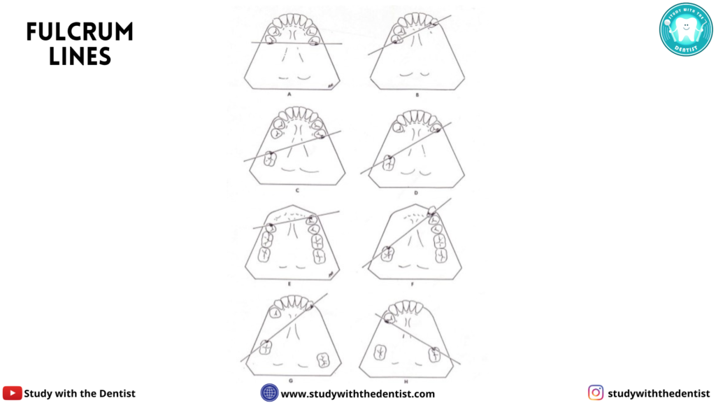 Parts of Removable Partial Denture Study With The Dentist (2022)